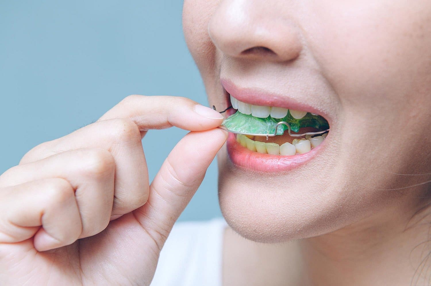 At Carpinello Orthodontics in Newtown Square, PA, a person uses their right hand to insert a green retainer as an orthodontic appliance.