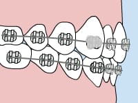 Teeth with braces, one bracket shaded to show an issue; Carpinello Orthodontics in Drexel Hill, Newtown Square or Edgmont, PA.