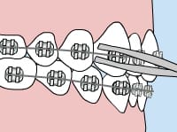 Dental braces with tweezers adjusting wire on brackets, at Carpinello Orthodontics in Drexel Hill, Newtown Square or Edgmont, PA.