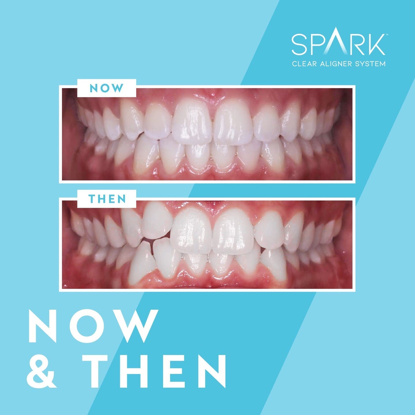 Before after dental treatment with SPARK Clear Aligner at Carpinello Orthodontics in Drexel Hill, PA.