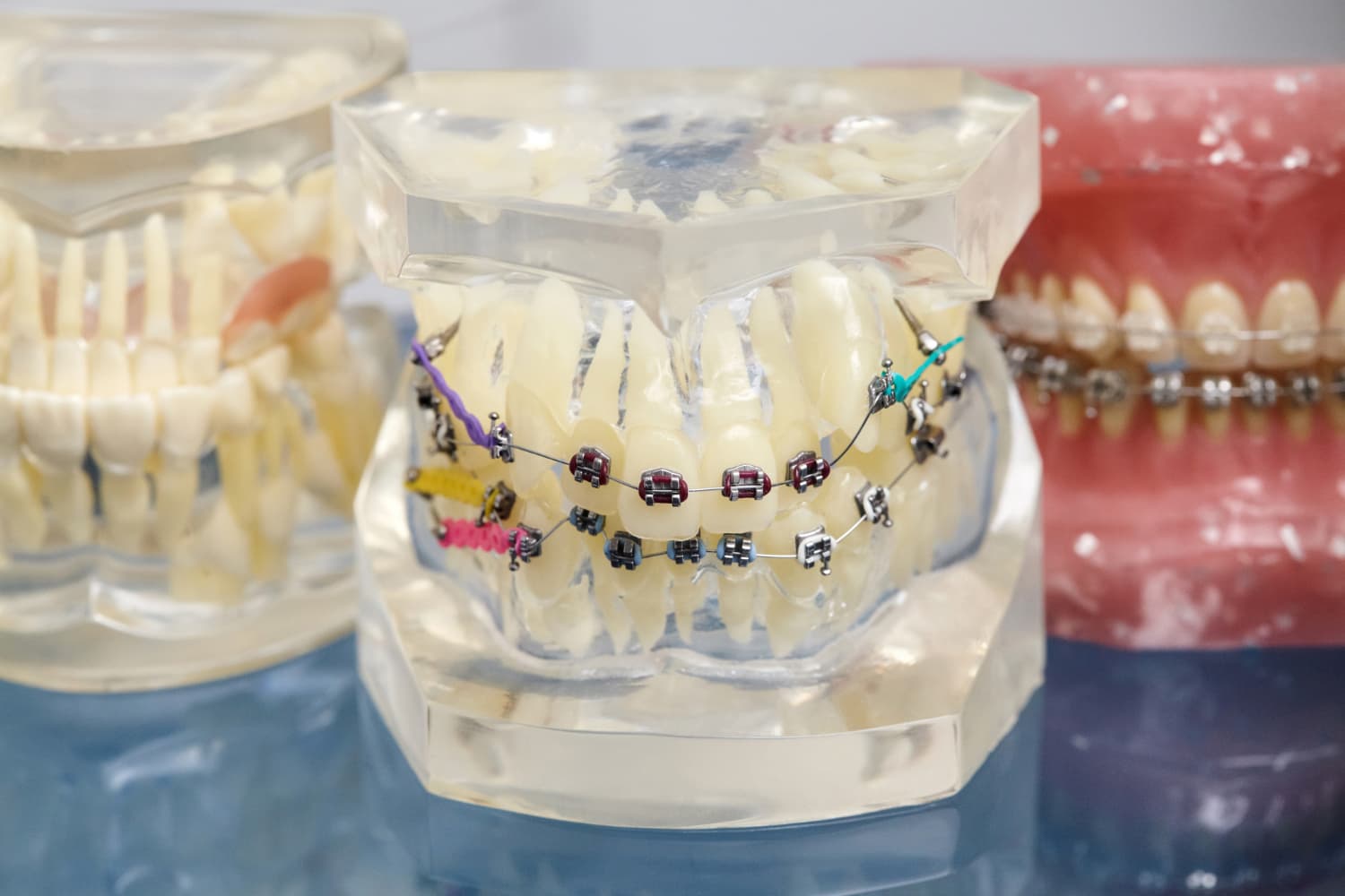Dental models with metal braces and colored bands from Carpinello Orthodontics in Drexel Hill, Newtown Square or Edgmont, PA.