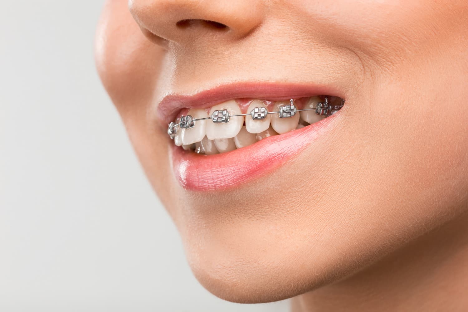 A close-up of a smiling person with metal braces shows early overbite signs, at Carpinello Orthodontics in Drexel Hill, Newtown Square or Edgmont, PA.