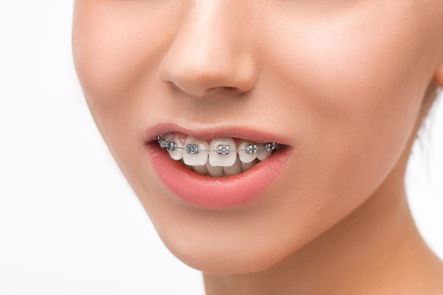A smiling mouth with metal braces for overjet and overbite, at Carpinello Orthodontics in Drexel Hill, Newtown Square or Edgmont, PA.