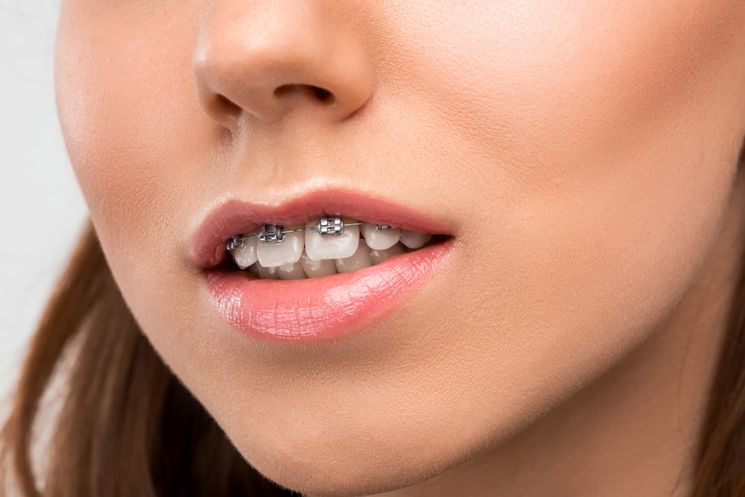 A woman's mouth with metal braces for overbite and overjet correction at Carpinello Orthodontics in Drexel Hill, Newtown Square or Edgmont, PA.