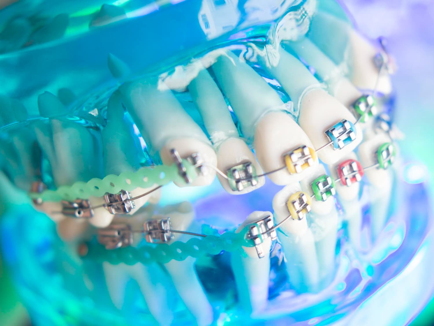 Dental model with metal braces and colorful elastics at Carpinello Orthodontics in Drexel Hill, Newtown Square or Edgmont, PA.