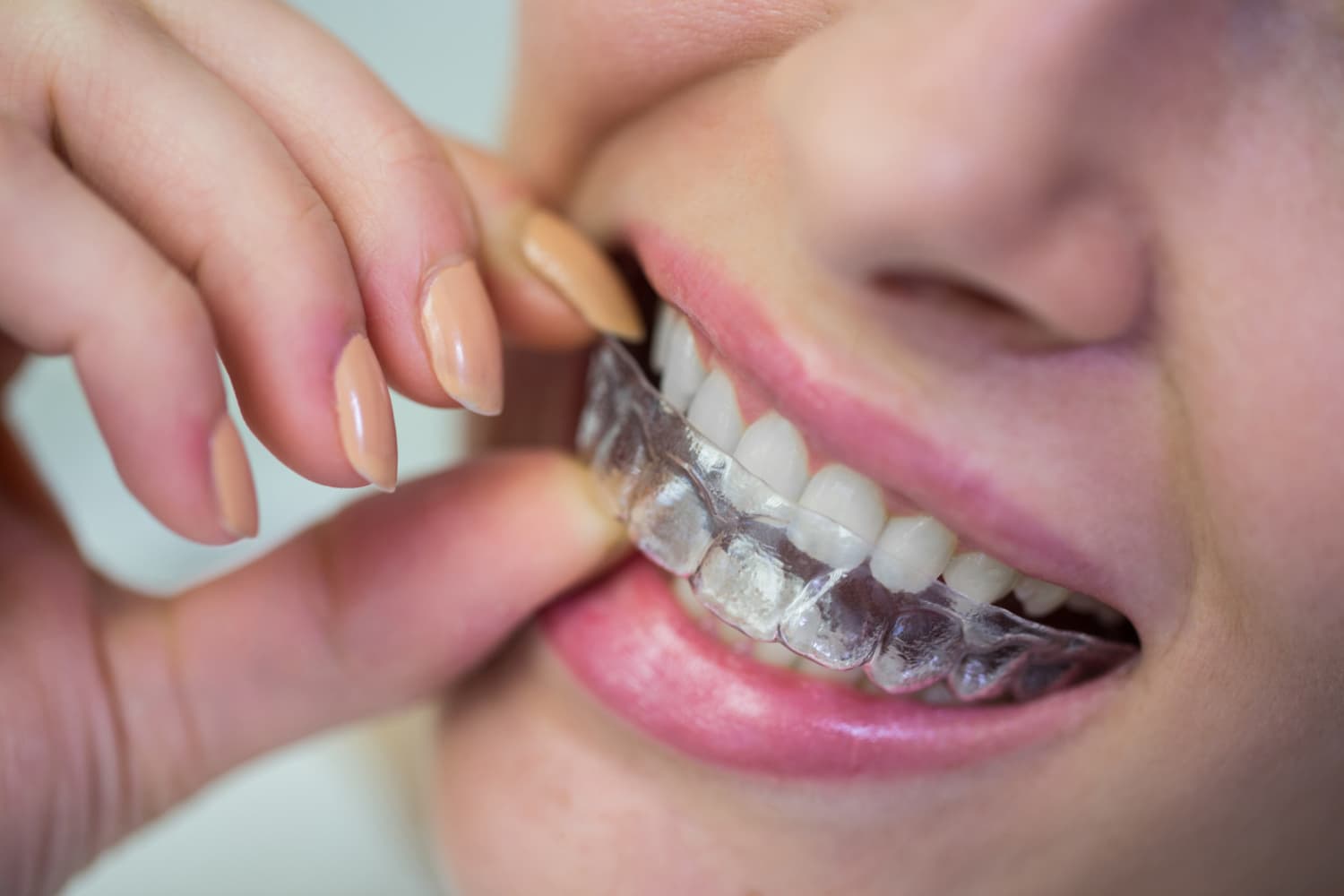 A person fits a clear aligner over their teeth, highlighting Invisalign Insurance at Carpinello Orthodontics in Drexel Hill, Newtown Square or Edgmont, PA.