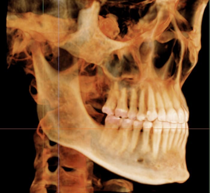 Dr. Fateh Arslan and Dr. David Carpinello Idilbi: Orthodontist in Edgmont PA A 3D CT scan shows a skull’s side view with bone structure and teeth at Carpinello Orthodontics in Drexel Hill, Newtown Square or Edgmont, PA.